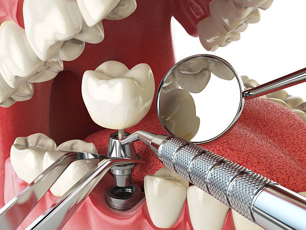 Best Emergency Tooth Extraction in Montana City, MT